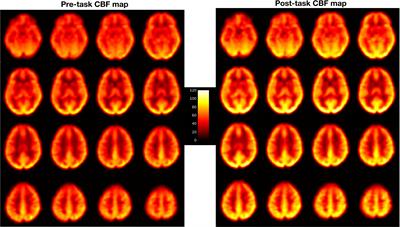 Perfusion Imaging of Fatigue and Time-on-Task Effects in Patients With Parkinson’s Disease